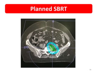 58
Planned SBRT
 