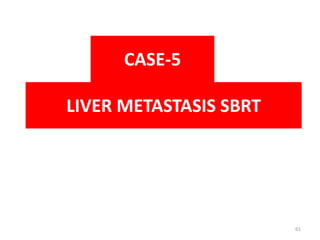 LIVER METASTASIS SBRT
CASE-5
61
 