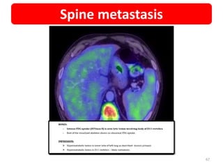 67
Spine metastasis
 