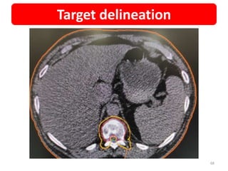 68
Target delineation
 