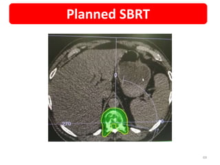 69
Planned SBRT
 