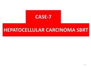 HEPATOCELLULAR CARCINOMA SBRT
CASE-7
71
 