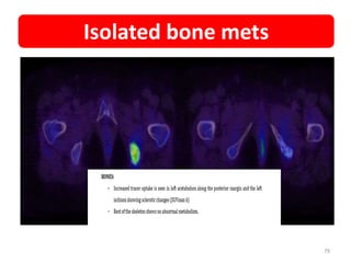 79
Isolated bone mets
 