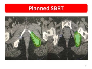 81
Planned SBRT
 