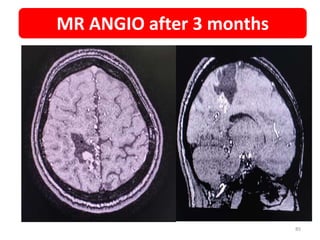 MR ANGIO after 3 months
85
 