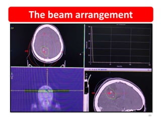 The beam arrangement
89
 