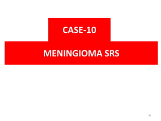 MENINGIOMA SRS
CASE-10
91
 