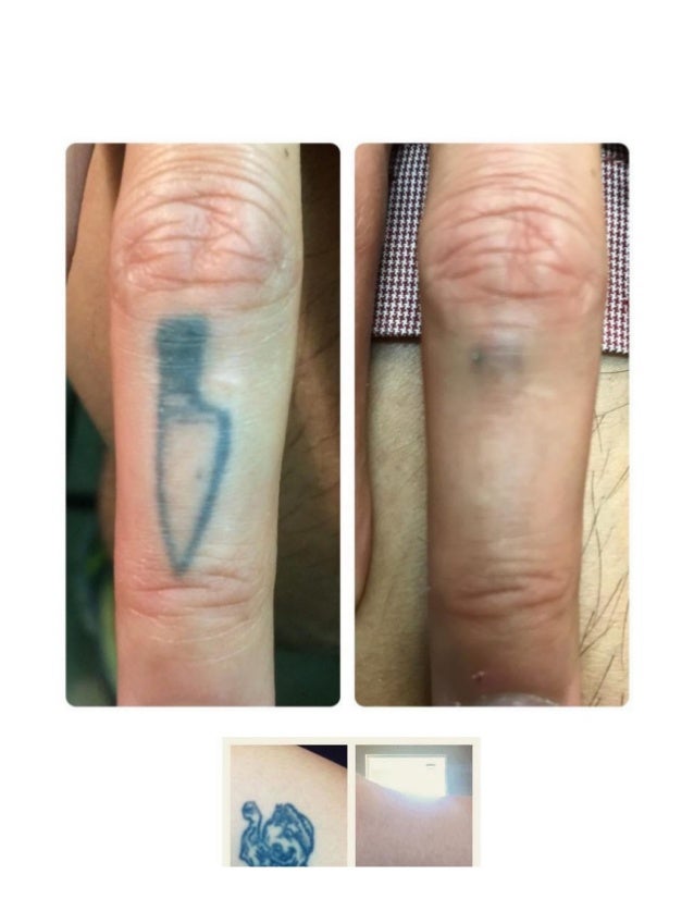 Our work tattoo removal clinic houston tx