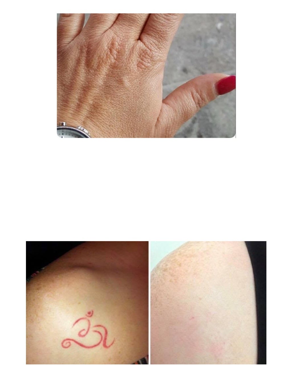 Our work tattoo removal clinic houston tx