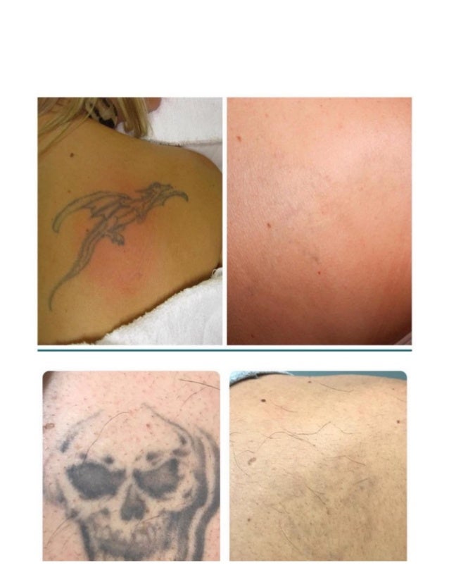 Our work tattoo removal clinic houston tx