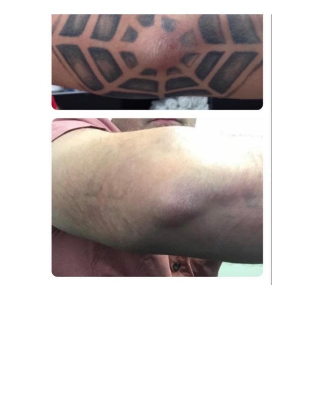 Our work tattoo removal clinic houston tx