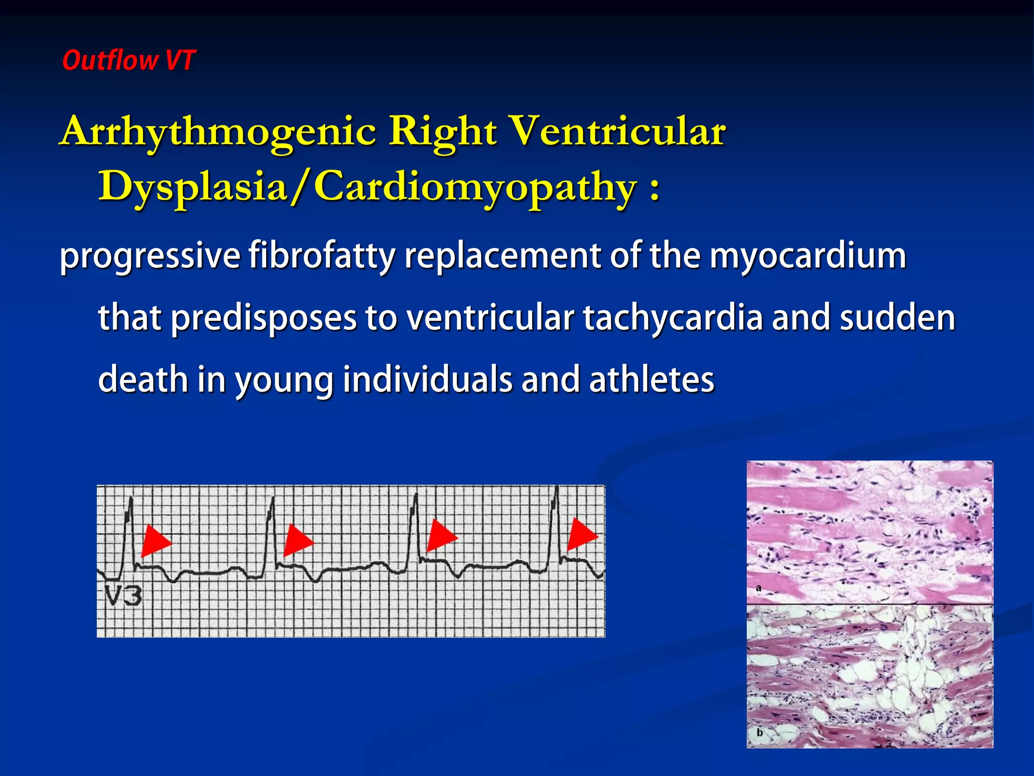 Arrhythmogenic Right Ventricular
Dysplasia/Cardiomyopathy :