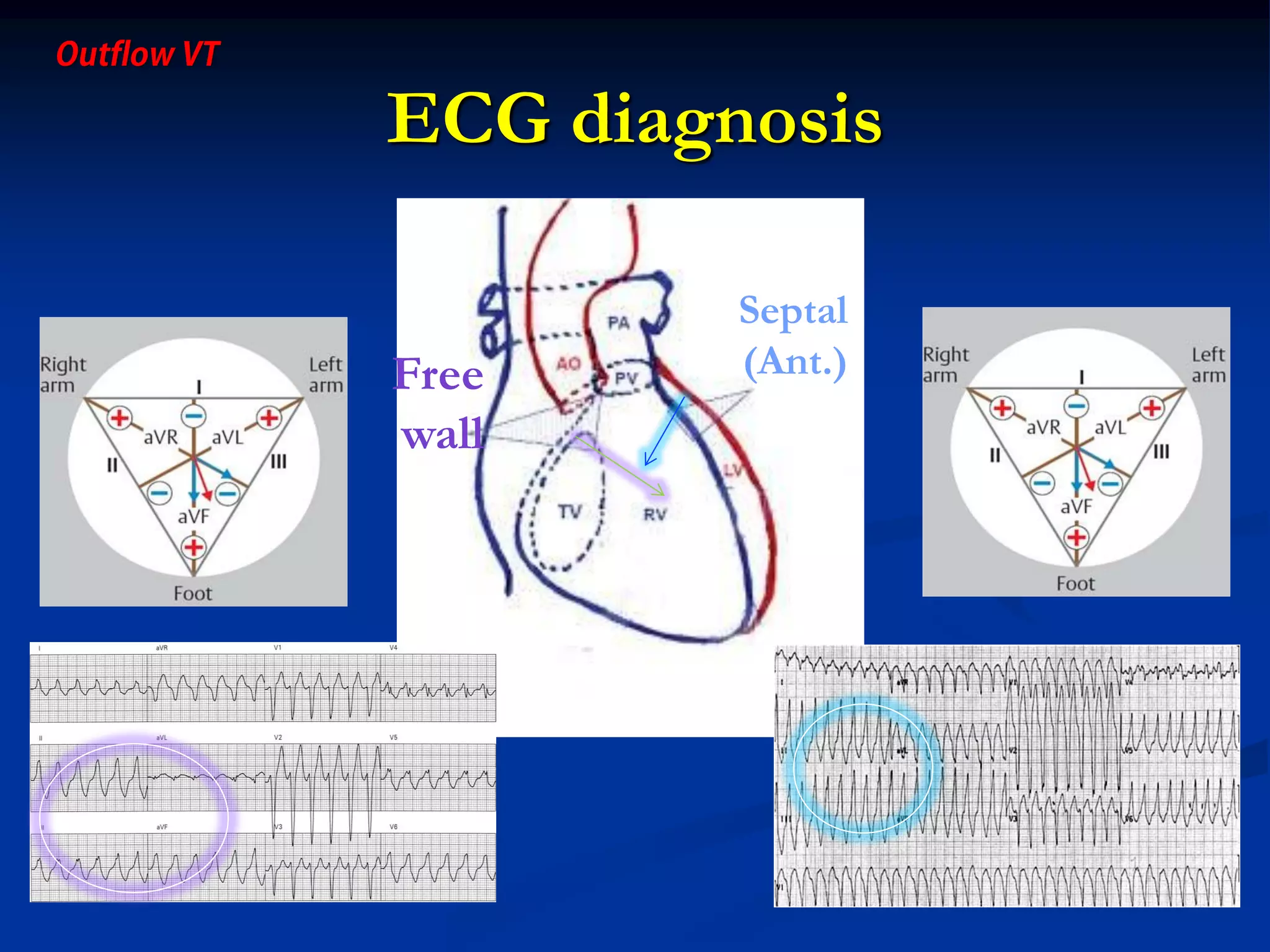 ECG diagnosis
Septal
(Ant.)Free
wall