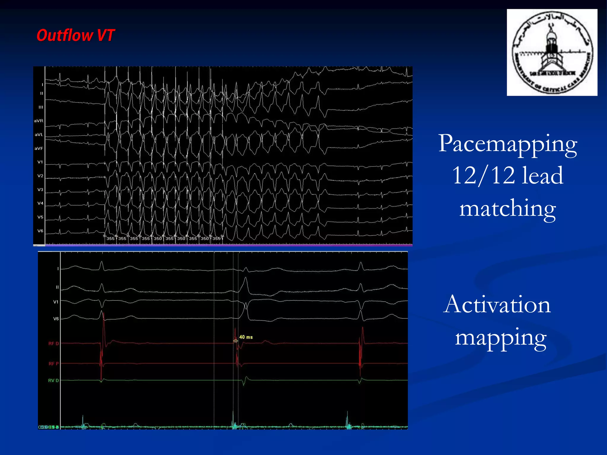 Pacemapping
12/12 lead
matching
Activation
mapping