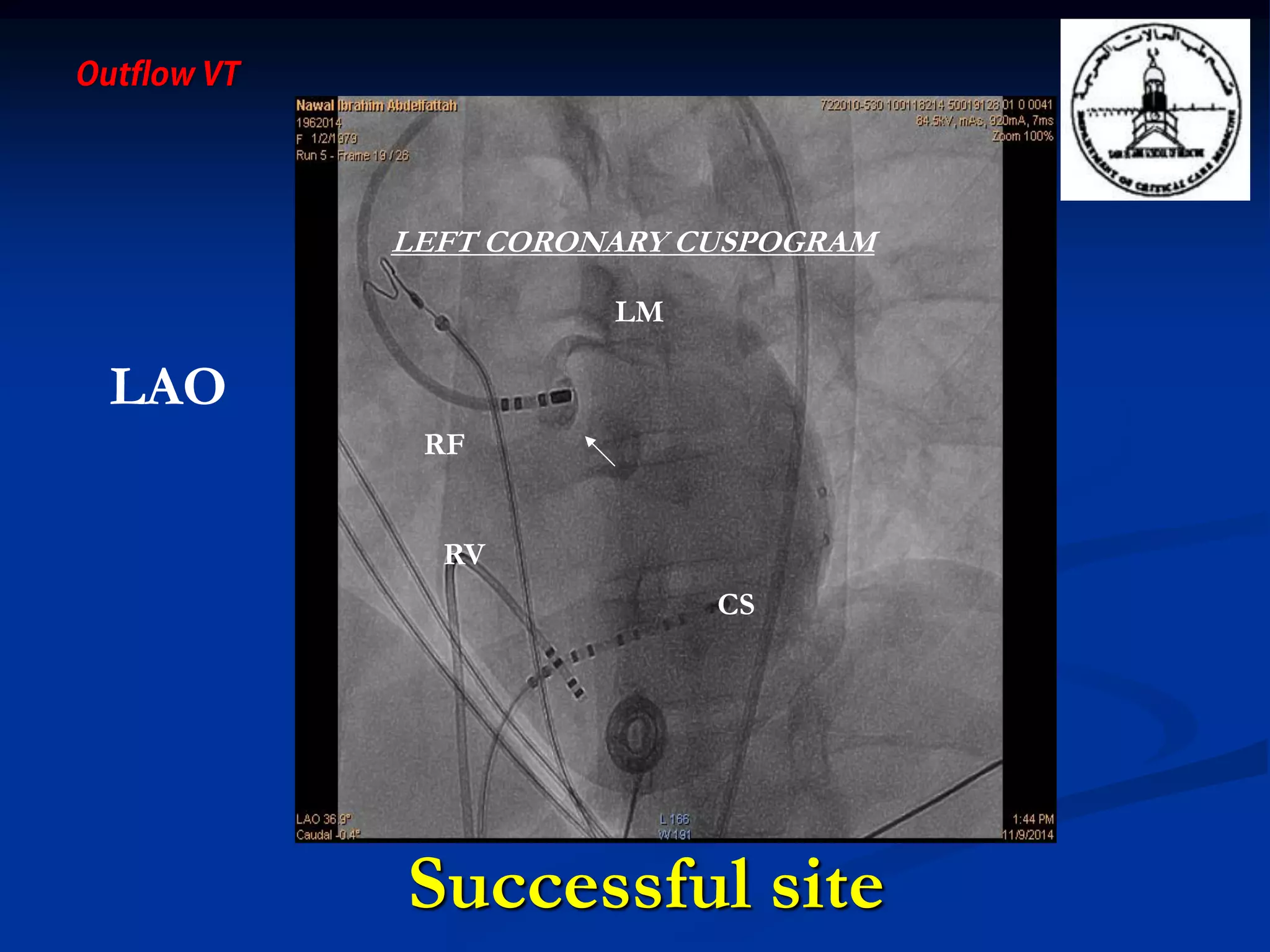 LEFT CORONARY CUSPOGRAM
LM
CS
RV
LAO
RF
Successful site