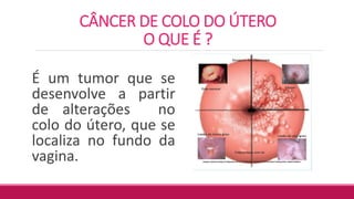 CÂNCER DE COLO DO ÚTERO
O QUE É ?
É um tumor que se
desenvolve a partir
de alterações no
colo do útero, que se
localiza no fundo da
vagina.
 
