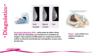 •Diagnóstico•
Ressonância Magnética (RM) – utiliza ondas de rádio e fortes
ímãs, além de computador, que transforma os resultados em
imagem. Tipos especiais de RM podem ser usados para analisar
melhor os cânceres encontrados por mamografias, ou para casos
de alto risco.
Biópsia – para analisar se o
nódulo é benigno ou
maligno;
 