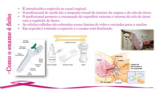 •Comooexameéfeito • É introduzido o espéculo no canal vaginal.
• O profissional de saúde faz a inspeção visual do interior da vagina e do colo do útero.
• O profissional promove a escamação da superfície externa e interna do colo do útero
com a espátula de Ayres.
• As células colhidas são colocadas numa lâmina de vidro e enviadas para a analise
• Em seguida é retirado o espéculo e o exame está finalizado.
 