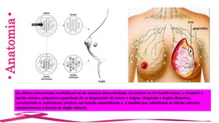 •Anatomia•
As células cancerizadas multiplicam-se de maneira descontrolada, acumulam-se formando tumor, e invadem o
tecido vizinho; adquirem capacidade de se desprender do tumor e migrar, chegando a órgãos distantes,
constituindo as metástases; perdem sua função especializada e, a medida que substituem as células normais,
comprometem a função do órgão afetado.
 