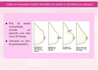 COMO AS MULHERES PODEM PERCEBER OS SINAIS E SINTOMAS DA DOENÇA?
 