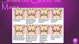 Sinais do Câncer de
Mama
Enfermagem
 