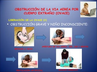 OBSTRUCCIÓN GRAVE Y NIÑO INCONSCIENTE: OBSTRUCCIÓN DE LA VIA AEREA POR CUERPO EXTRAÑO (OVACE) LIBERACIÓN DE LA OVACE (V) REVISAR LA BOCA APERTURA DE VIA AEREA. VER, OIR Y SENTIR VENTILACIÓN ARTIFICIAL MASAJE CARDIACO