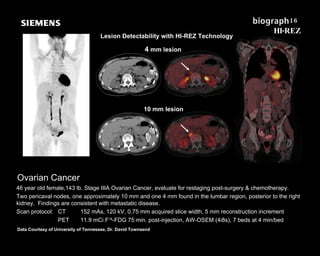 Ovarian Cancer 46 year old female,143 lb. Stage IIIA Ovarian Cancer, evaluate for restaging post-surgery & chemotherapy. Two pericaval nodes, one approximately 10 mm and one 4 mm found in the lumbar region, posterior to the right kidney.  Findings are consistent with metastatic disease. Scan protocol:  CT 152 mAs, 120 kV, 0.75 mm acquired slice width, 5 mm reconstruction increment    PET 11.9 mCi F 18 -FDG 75 min. post-injection, AW-OSEM (4i8s), 7 beds at 4 min/bed Data Courtesy of University of Tennessee, Dr. David Townsend  4  mm lesion 10 mm lesion Lesion Detectability with HI-REZ Technology 16   HI-REZ 