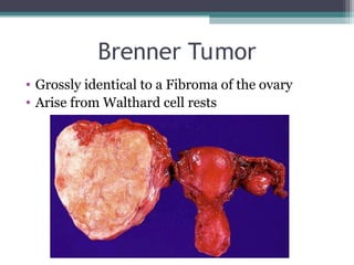 Walthard Rests Man OVARIAN-CA by department of Obs gyne FEY-NRMF | PPT