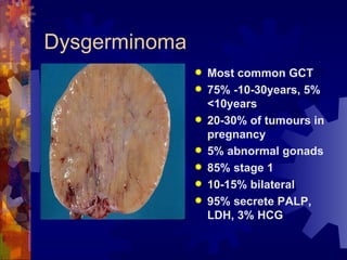 Dysgerminoma Most common GCT 75% -10-30years, 5% <10years 20-30% of tumours in pregnancy 5% abnormal gonads 85% stage 1 10-15% bilateral 95% secrete PALP, LDH, 3% HCG 