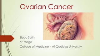 Ovarian Cancer 
Ziyad Salih 
6th stage 
Collage of Medicine – Al-Qadisiya University 
 