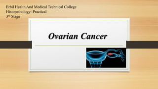 Erbil Health And Medical Technical College
Histopathology- Practical
3rd Stage
Ovarian Cancer
 