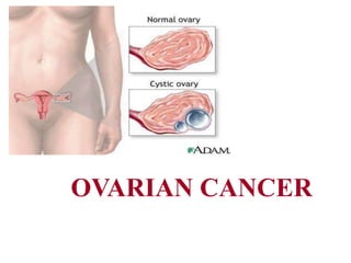 OVARIAN CANCER
 