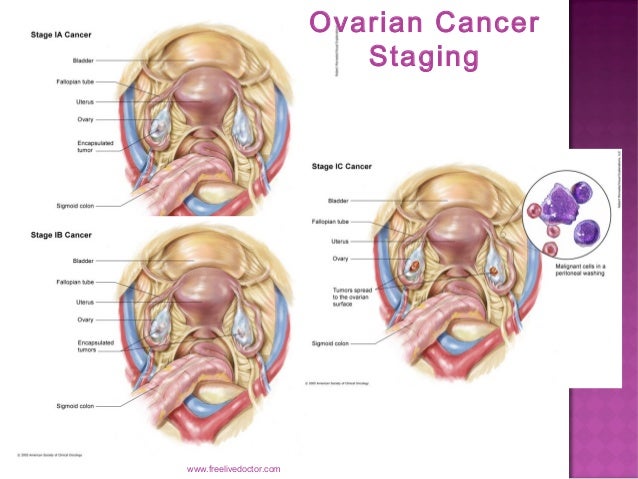 ovarian carcinoma by dr wasif ullah