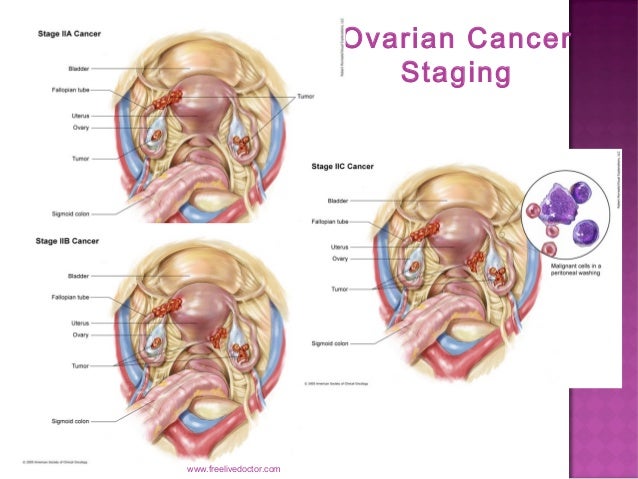 Ovarian liver cancer stages
