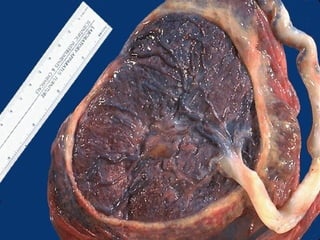 This is a circumvallate placenta in which the membranes double back for a
short distance over the fetal surface when the chorionic plate is too small.
There may be increased fetal loss with this condition.
 