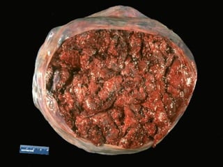 The maternal surface of a normal term placenta is seen here. Note that the
cotyledons that form the placenta are reddish brown and indistinct.
 