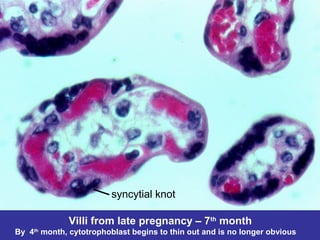 Villi from late pregnancy – 7th
month
By 4th
month, cytotrophoblast begins to thin out and is no longer obvious
syncytial knot
 