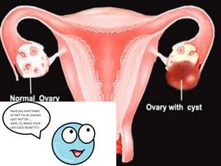 Ovarian cyst
 