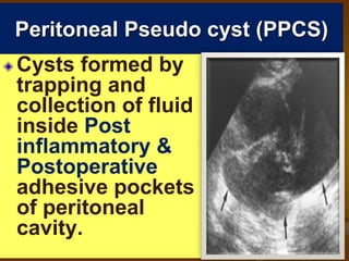 Peritoneal Pseudo cyst (PPCS)
Cysts formed by
trapping and
collection of fluid
inside Post
inflammatory &
Postoperative
adhesive pockets
of peritoneal
cavity.
 