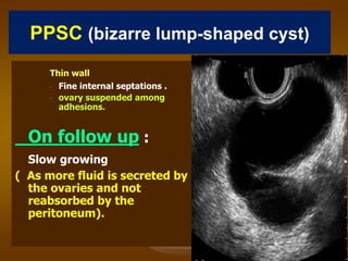 PPSC (bizarre lump-shaped cyst)
Thin wall
• Fine internal septations .
• ovary suspended among
adhesions.
On follow up :
Slow growing
( As more fluid is secreted by
the ovaries and not
reabsorbed by the
peritoneum).
 