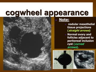 cogwheel appearance
Note:
nodular mesothelial
tissue projections
(straight arrows)
Normal ovary and
follicles adjacent to
peritoneal inclusion
cyst (curved
arrows).
 