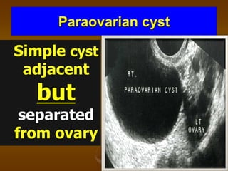 Paraovarian cyst
Simple cyst
adjacent
but
separated
from ovary
 
