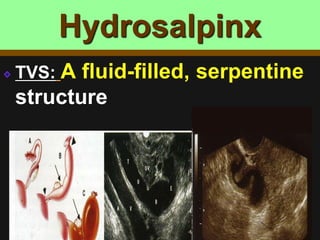 Hydrosalpinx
TVS: A fluid-filled, serpentine
structure
 
