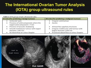 The International Ovarian Tumor Analysis
(IOTA) group ultrasound rules
 