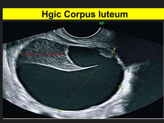 Hgic Corpus luteum
 