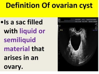 Definition Of ovarian cyst
•Is a sac filled
with liquid or
semiliquid
material that
arises in an
ovary.
 