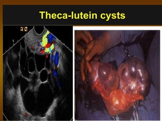 Theca-lutein cysts
 