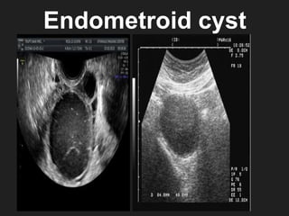 Endometroid cyst
 