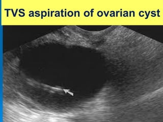 TVS aspiration of ovarian cyst
 