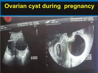 Ovarian cyst during pregnancy
 